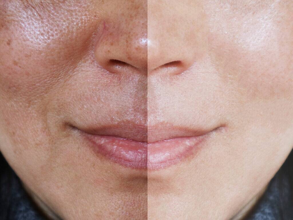BB Glow – Behandlung, Vorteile und Erfahrungsberichte 1 BB Glow Treatment Everything You Need To Know 1