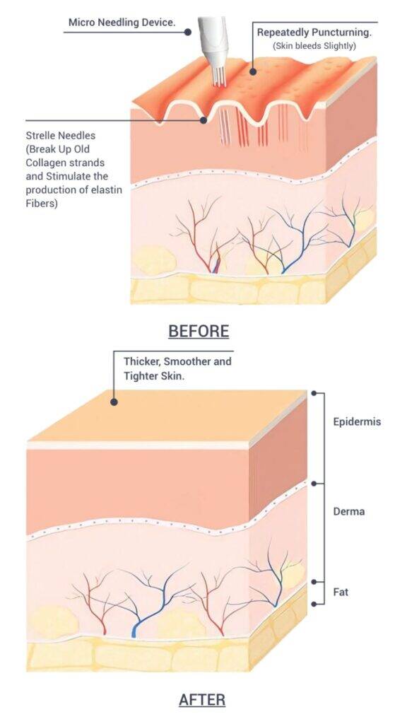 microneedlin mobile