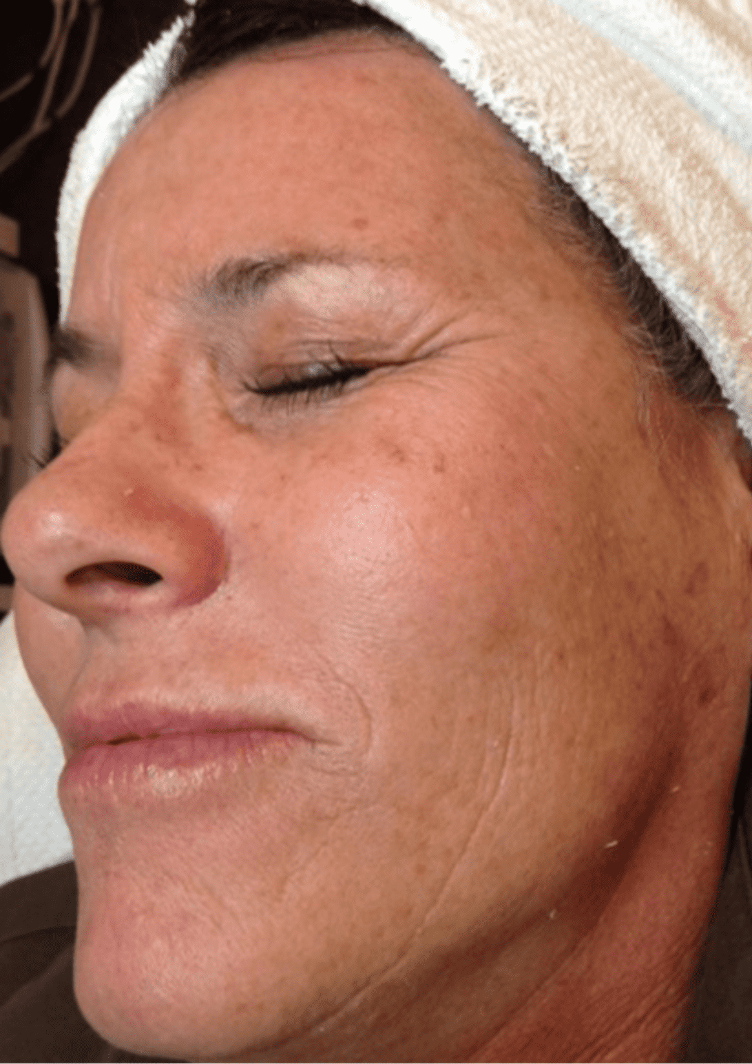 Diamant Microdermabrasion 2 microdermabrasion wien