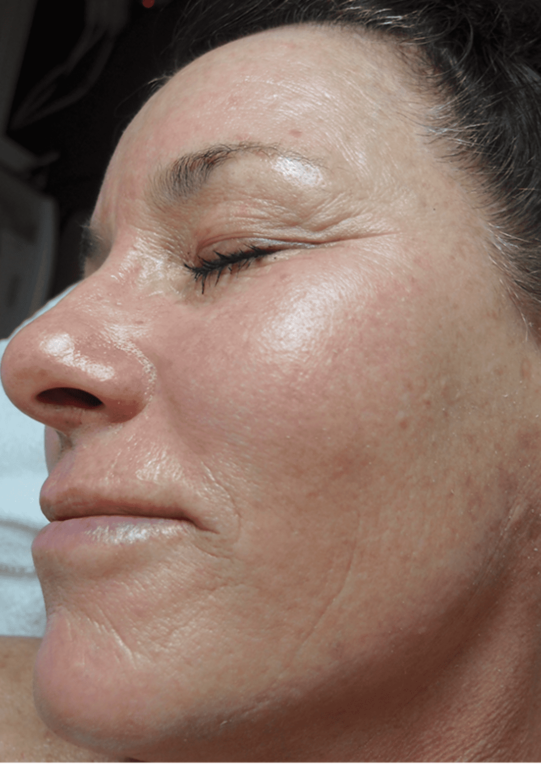 Diamant Microdermabrasion 3 microdermabrasion wien