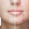 Aknebehandlung mit Fruchtsäurepeeling  (60 Min)