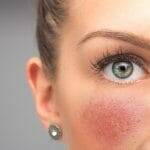 Sensible Haut und Rosacea 