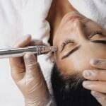 Microneedling