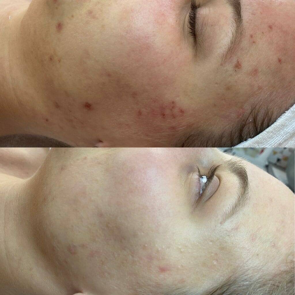 Die besten Microneedling vorher nachher Ergebnisse: Vor- und Nachteile im Überblick 3 80ccabfc 62fd 40d9 9cc7 b0a01deb89a6