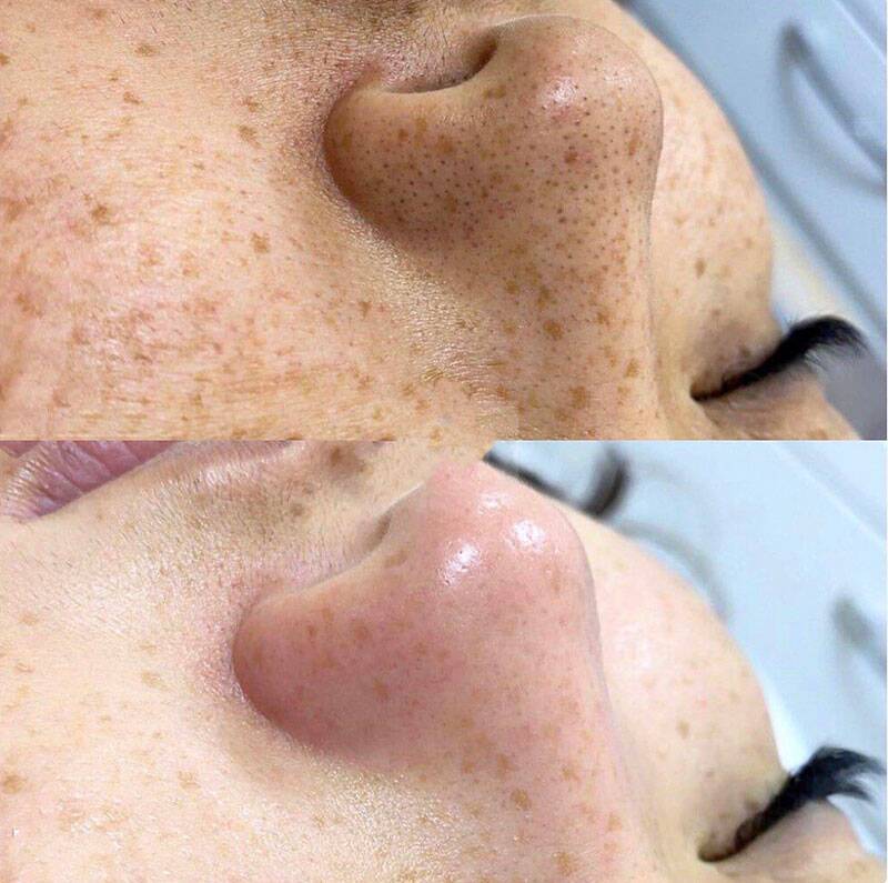 Die besten Microneedling vorher nachher Ergebnisse: Vor- und Nachteile im Überblick 4 Pigment vorher nachher
