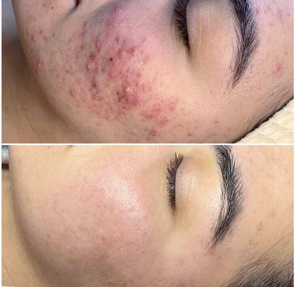 IPL Laser Wien – Laser-Gesichtsbehandlungen 10 Biorepeel Wien