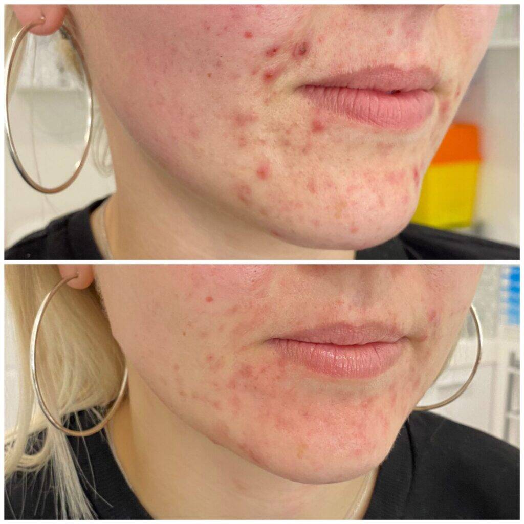 IPL Laser Wien – Laser-Gesichtsbehandlungen 9 Biorepeel Wien