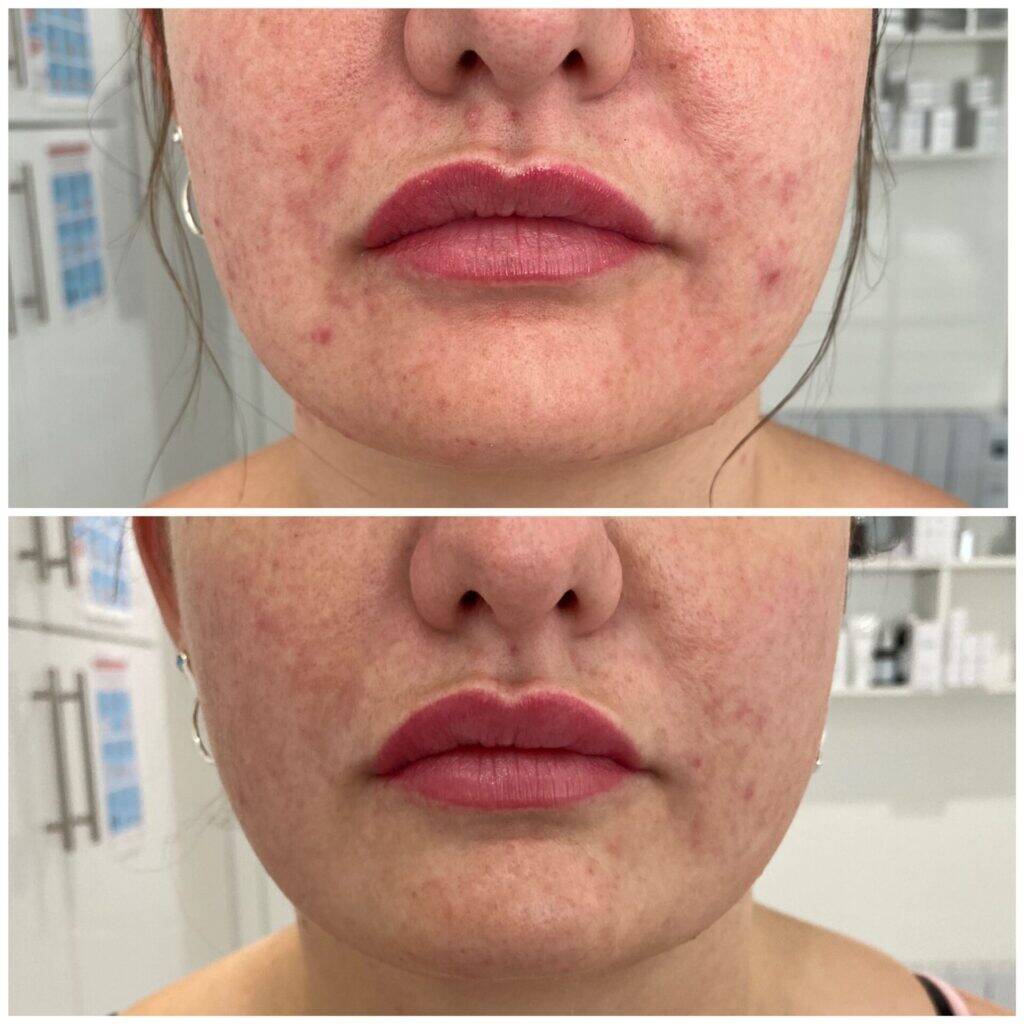 IPL Laser Wien – Laser-Gesichtsbehandlungen 8 Biorepeel Wien