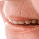 Mund/Lippenfalten