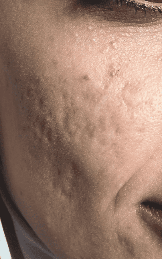 akne scars
