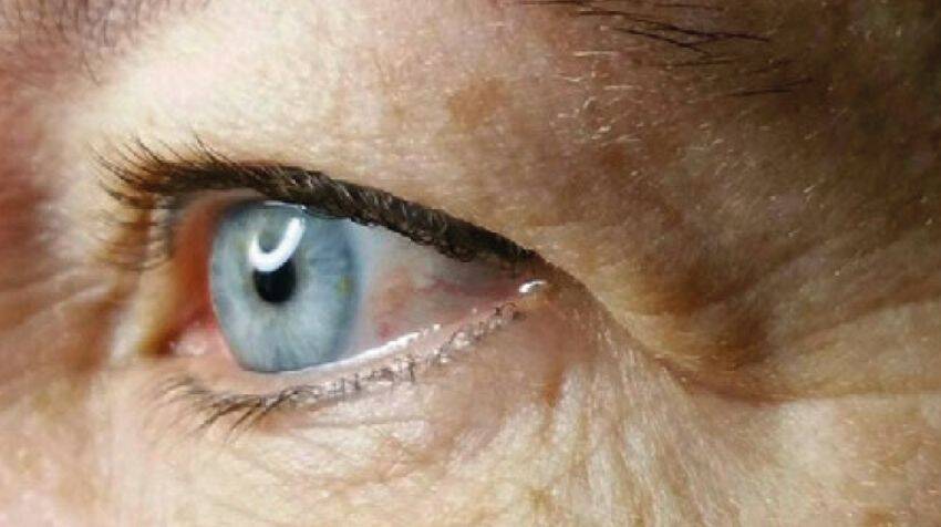 Augenlidstraffung Wien 3 eyelid 1