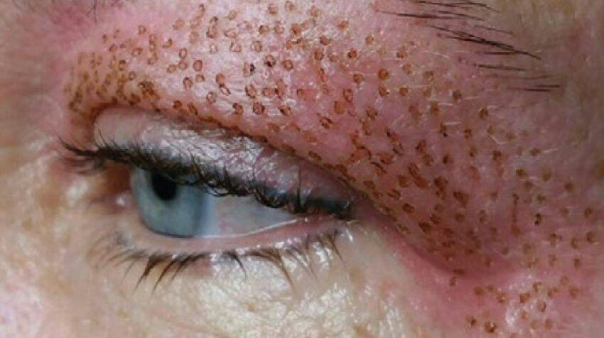 Augenlidstraffung Wien 4 eyelid 2