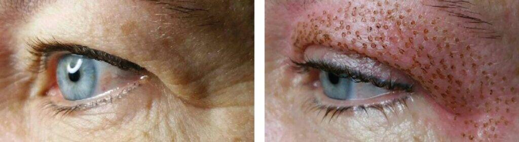 Augenlidstraffung Wien 5 eyelid 3