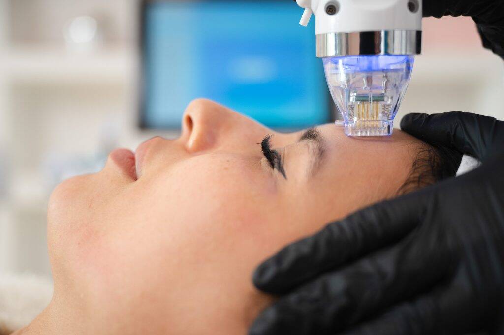 Radiofrequenz Microneedling 1 Radiofrequenz Micron