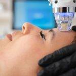 Augenfalten entfernen mit RF Needling (50 Min)