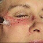Augenringe Behandlung mit Global Eyecon + Microneedling (45 Min)