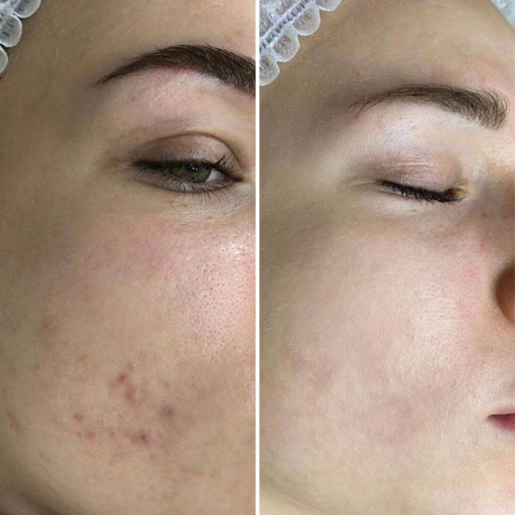 carbon peeling vorher nachher