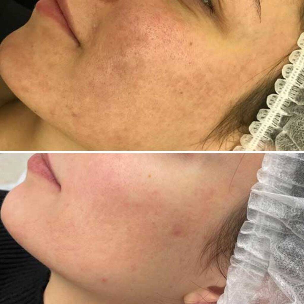 carbon peeling vorher nachher