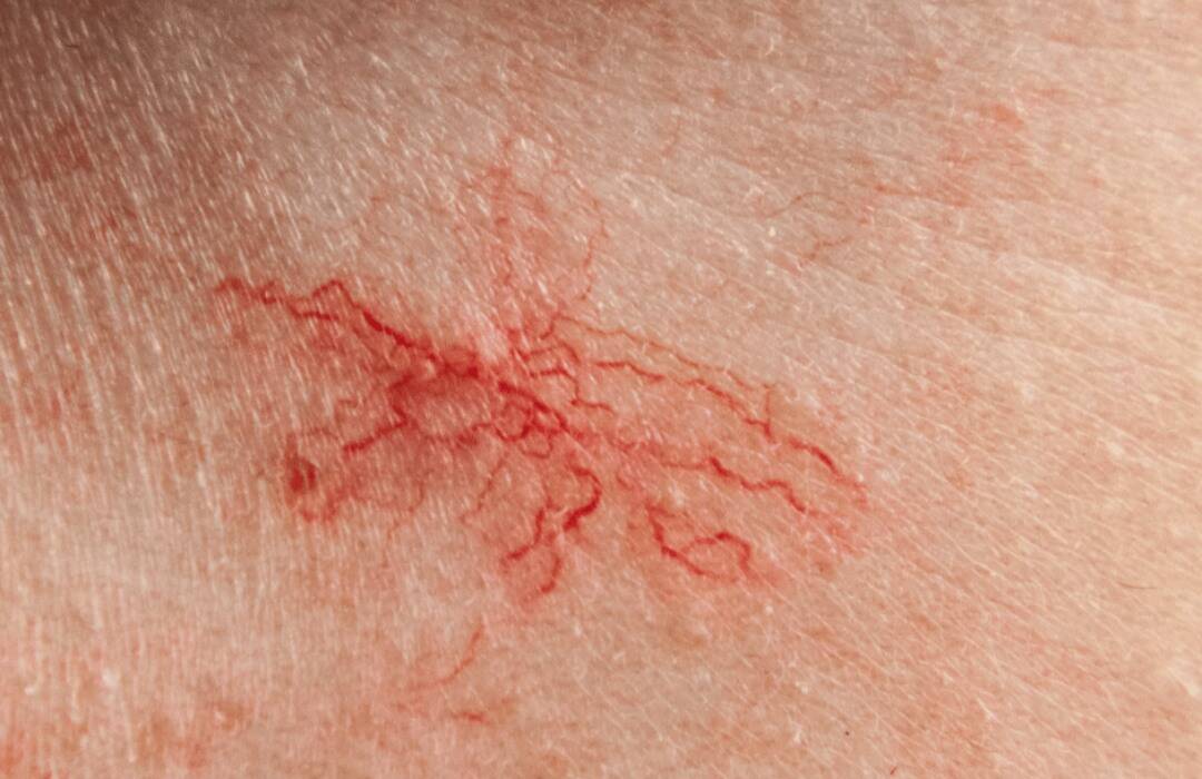 IPL Laser Wien – Laser-Gesichtsbehandlungen 5 IPL Akne 2