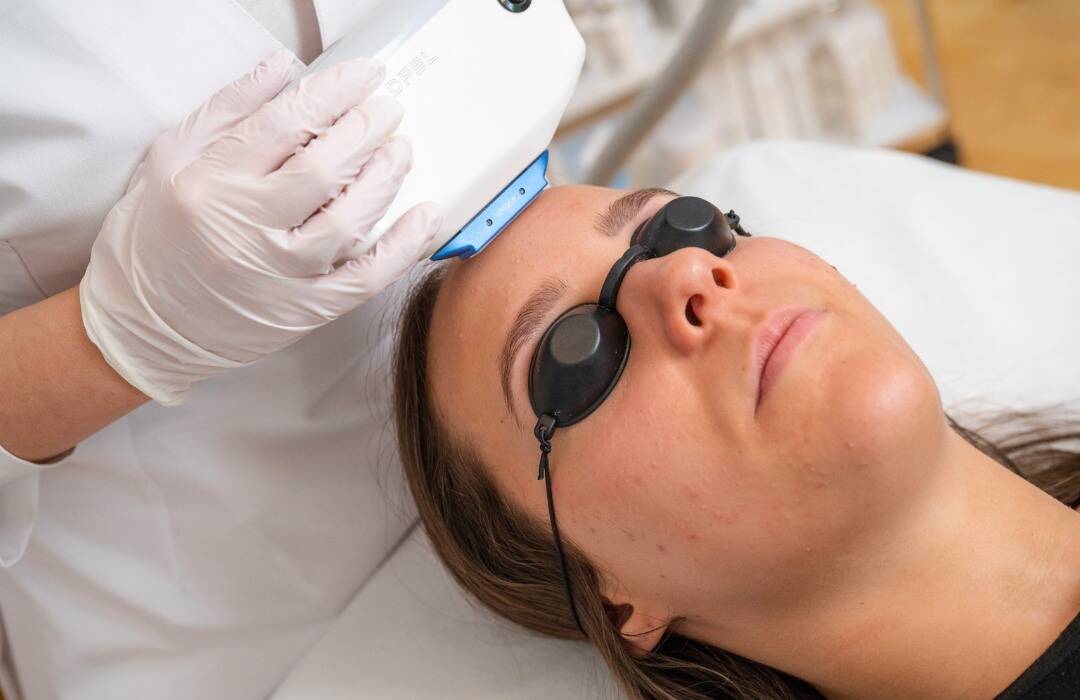 IPL Laser Wien – Laser-Gesichtsbehandlungen 7 IPL Akne 4