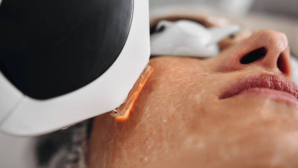 IPL Laser Wien – Laser-Gesichtsbehandlungen 1 intense pulsed light