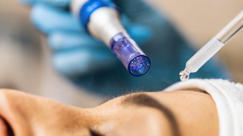 Doppelkinn entfernen Wien – die besten Methoden ohne OP 3 Microneedling 1