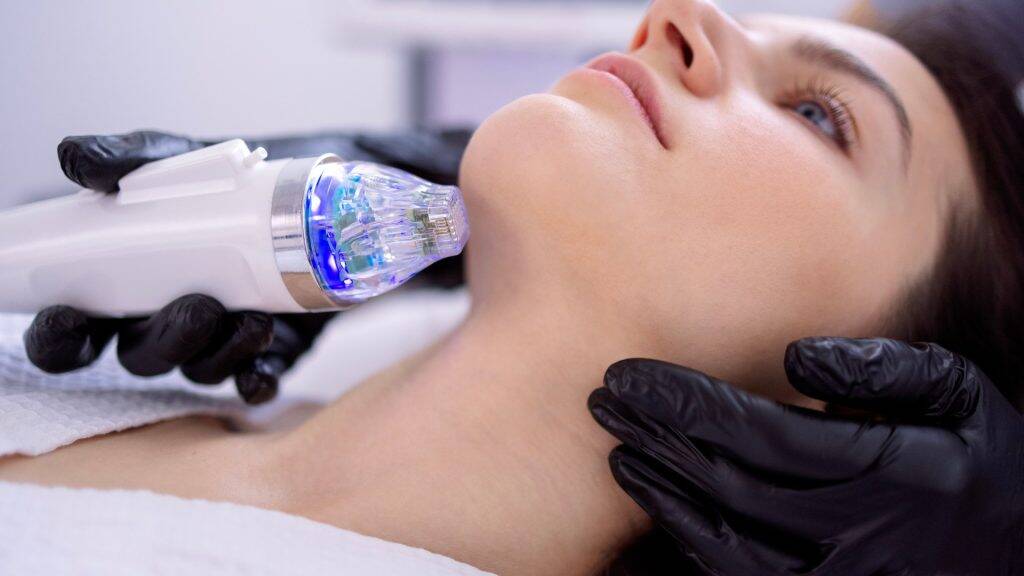 Radiofrequenz Microneedling 15 RF Needling 1