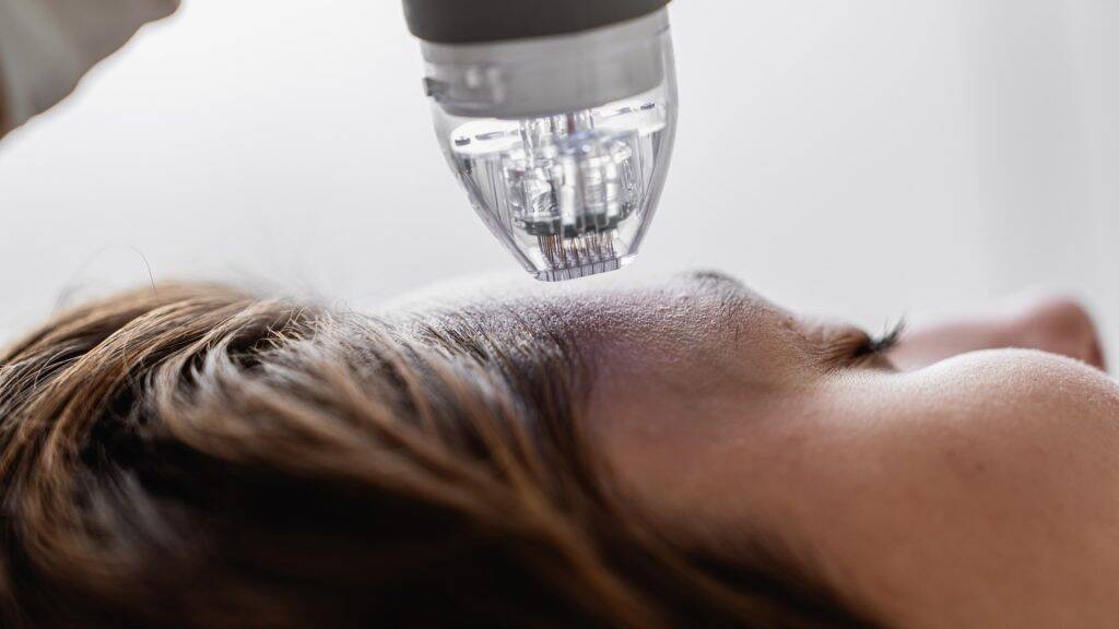 Radiofrequenz Microneedling 7 RF Needling