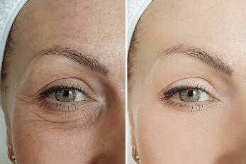 Microneedling Vorher Nachher Augen: Eine umfassende Anleitung für strahlende Augen 2 microneedling under eyes proneedling us