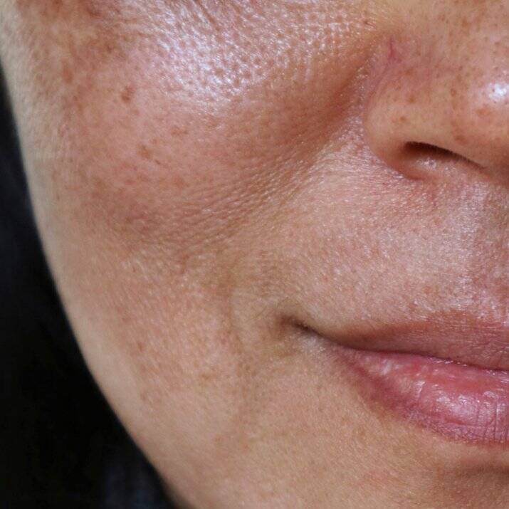 Couperose Behandlung Wien mit mesopeel MD azelan rx 3 MELANO OUT BEFORE 2