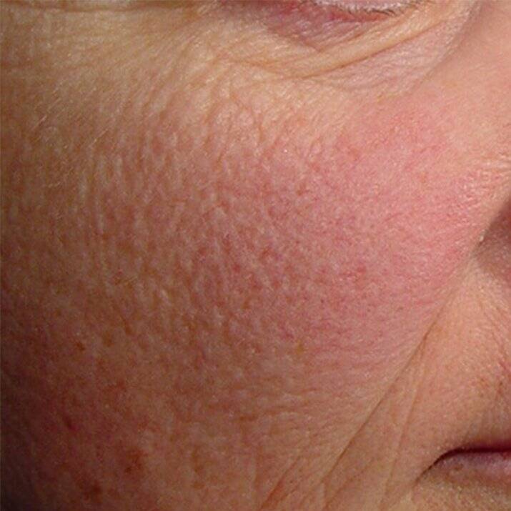 Couperose Behandlung Wien mit mesopeel MD azelan rx 4 couperose 2 before 4