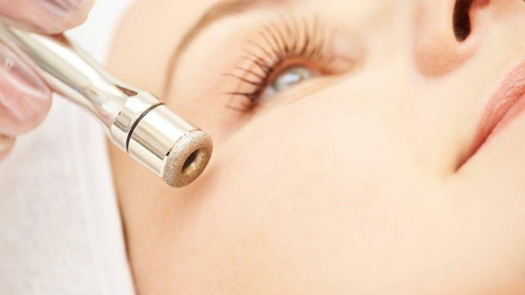 Diamant Microdermabrasion