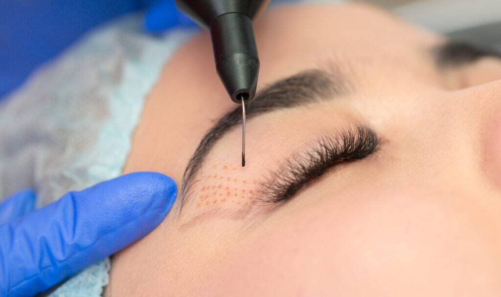 Plasma Pen Behandlung Wien