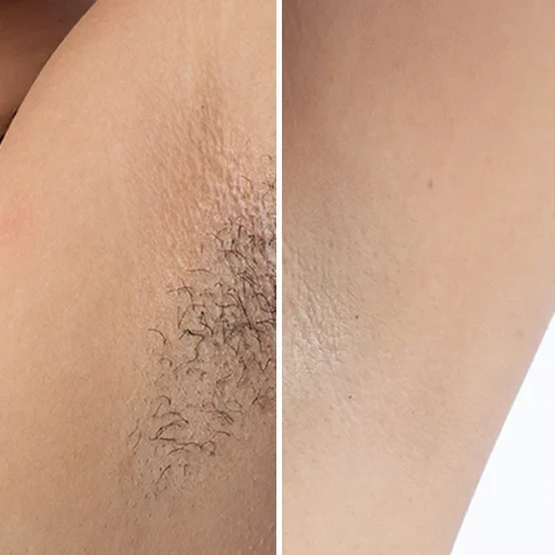 Laser Hair before after