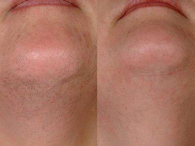 LaserHair Removal before after 3