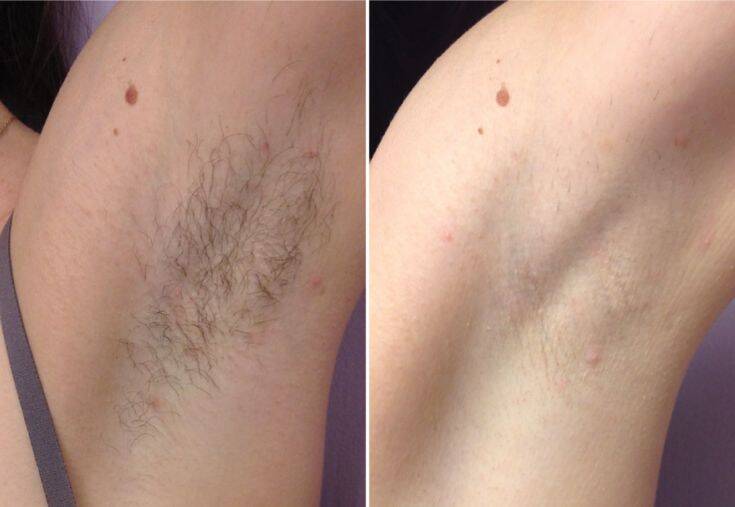 LaserHair Removal before after