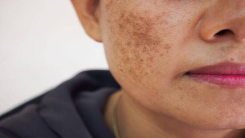dark spots