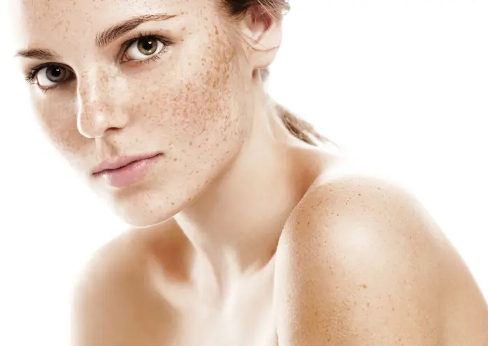 freckles