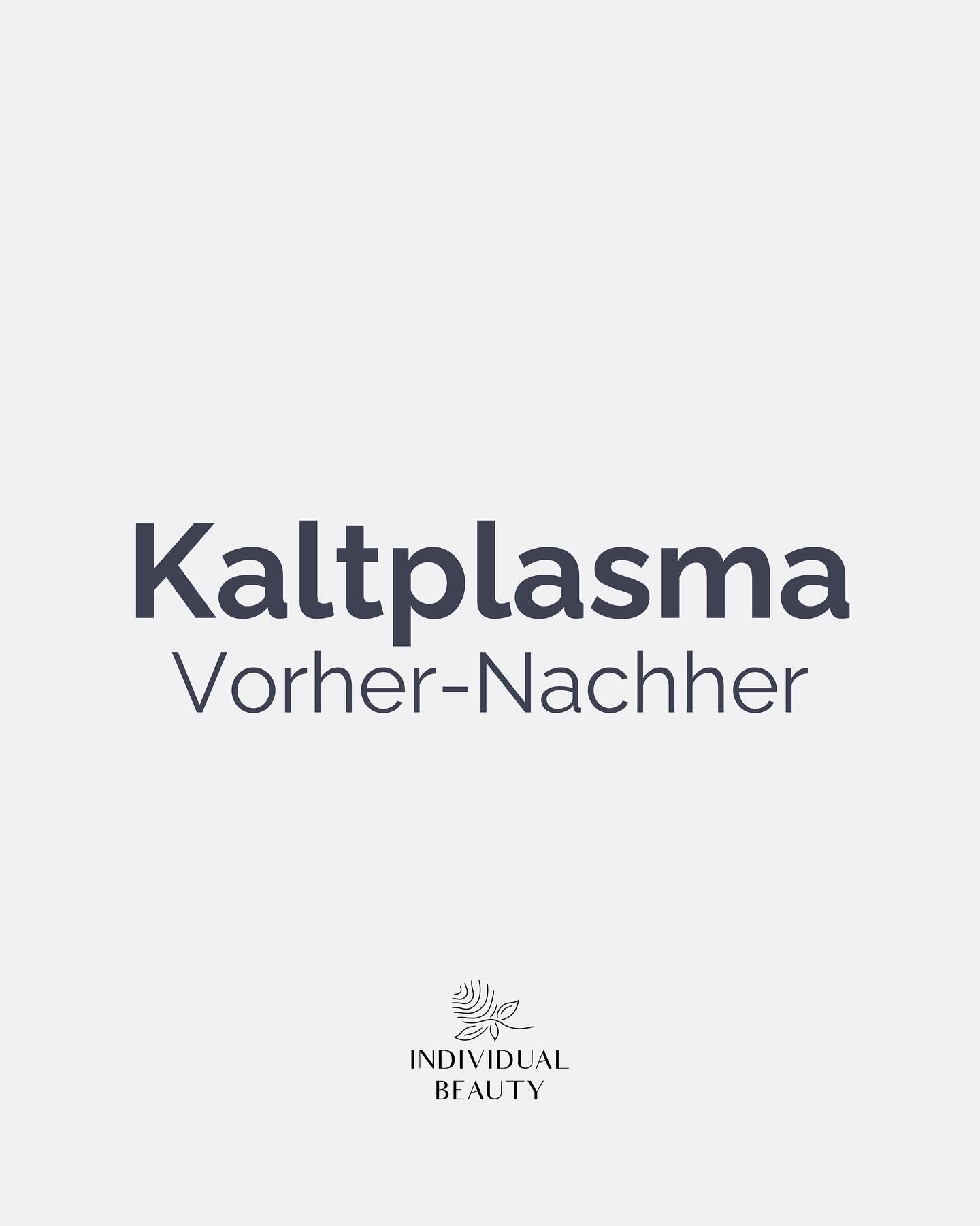 „Endlich etwas, das wirklich funktioniert – und nicht nur verspricht.“
Weißt du, warum Pickel immer wieder kommen – selbst wenn du alles richtig machst? Weil Bakterien tief in den Poren sitzen, und die normale Pflege sie oft gar nicht erreicht.
Und hier kommt etwas ins Spiel, das fast wie aus einer Wissenschaftsshow klingt: Kaltplasma.
👉 Aber was passiert da eigentlich? Die Luft besteht aus Gasen wie Sauerstoff, Stickstoff, Kohlendioxid. Wenn diese Gase in einem speziellen Gerät mit Energie angeregt werden, verändert sich ihr Zustand – und es entsteht Kaltplasma.
Wie ein vierter Aggregatzustand: also nicht fest, nicht flüssig und auch nicht einfach gasförmig, sondern ein besonderer Zwischenzustand.
Dieses Kaltplasma bildet sehr reaktionsfreudige Teilchen, die eine spannende Wirkungen entfalten können
– sie töten die Bakterien ab, die Akne verursachen
– sie regen die Durchblutung an, sodass die Haut sich schneller regenerieren kann
– sie machen die Hautbarriere aufnahmefähiger für Pflegeprodukte
Das fühlt sich nicht invasiv oder schmerzhaft an – eher wie ein leichtes Kribbeln oder Wärme auf der Haut.
Das Ergebnis: weniger Entzündungen, weniger Rötungen, klare Haut. Die Wirkung ist sofort messbar, weil die Haut „neu durchatmet“.
Darum sagen viele nach den ersten Behandlungen:
Endlich eine Methode, die hält, was sie verspricht.
#wienbeauty #viennabeauty #kaltplasma #acnetreatment #aknebehandlung #akne #hautpflege #hautgesundheit #skincarecommunity #clearskin #beautytreatment #wien #vienna #austria #igersvienna #wienliebe