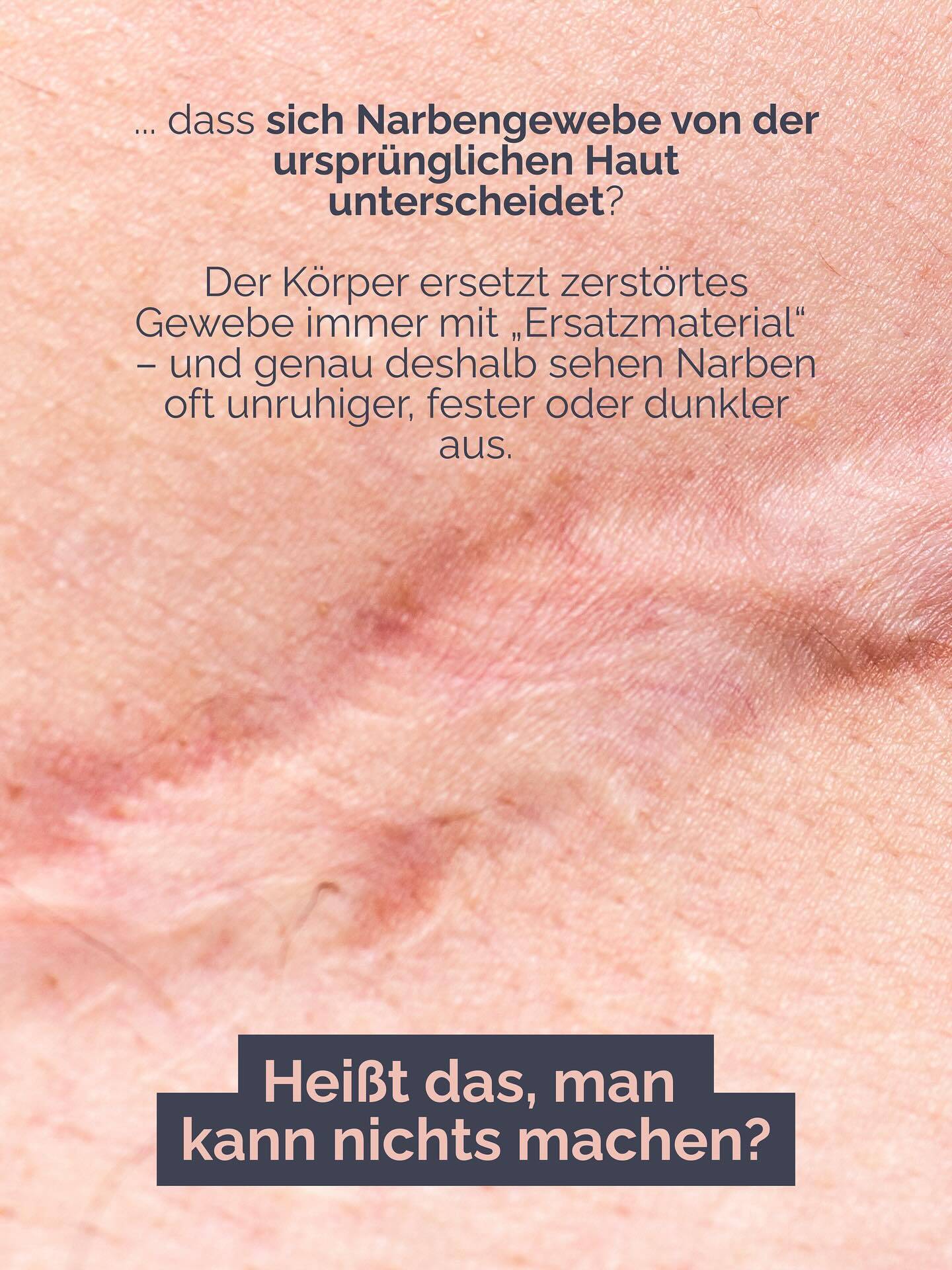 Viele denken, Narben heilen einfach von selbst.
Die Wahrheit ist: die Haut braucht Unterstützung – sonst bleiben die Spuren länger sichtbar.
Darum teilen wir hier unsere Empfehlungen für die Narbenpflege:
✨ Retinol für die Zellerneuerung
✨ Peeling-Booster für eine gleichmäßige Struktur
✨ Sonnenschutz, damit Narben nicht dunkler werden
✨ Spezielle Pflege, die das Gewebe beruhigt
#wienbeauty #viennabeauty #aknenarben #narbenpflege #aknebehandlung #hautpflege #skincare #narben #clearskin #skincarecommunity #beautytreatment #selfcare #hautgesundheit #wien #vienna #austria #wienliebe