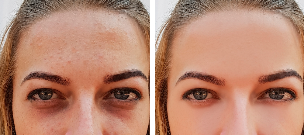 cyst removal microneedling 9