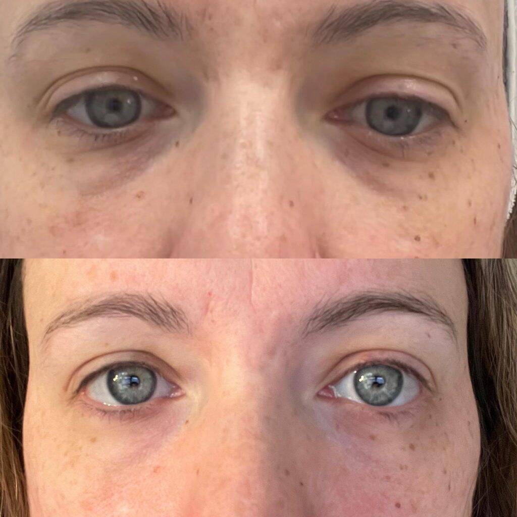 micro needling for under eyes v0 gyr07to76ied1