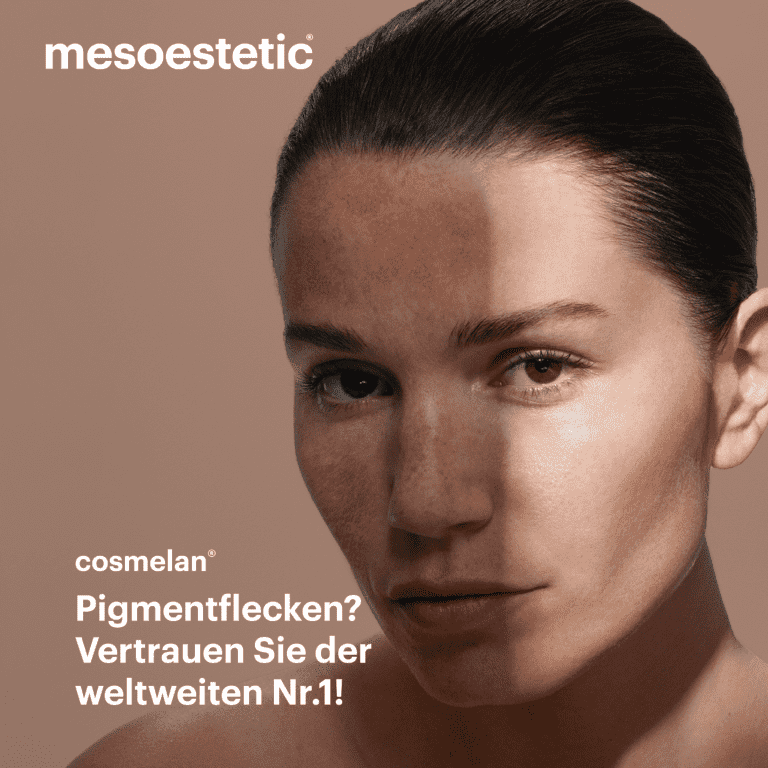 Pigmentflecken entfernen mit Cosmelan 3 Pigmentflecken entfernen Wien