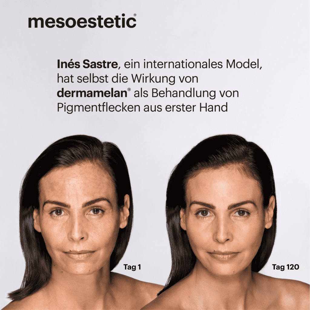 Pigmentflecken entfernen mit Cosmelan 2 Cosmelan Behandlung Wien