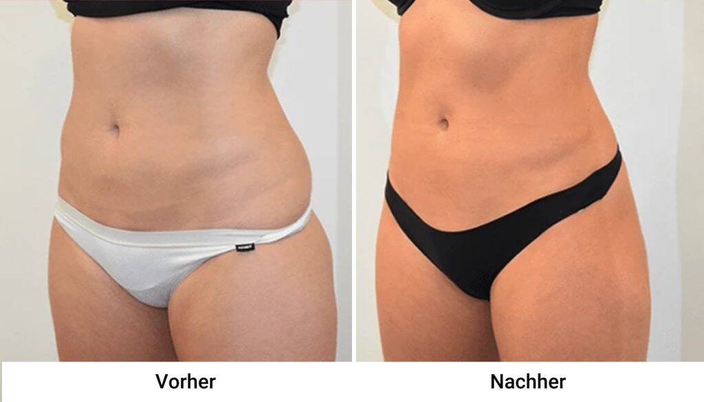 Kryolipolysis Vorher Nachher 1