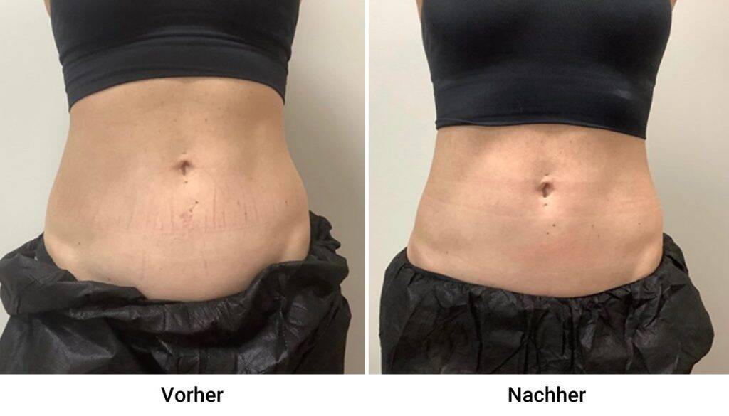 Kryolipolysis Vorher Nachher 3
