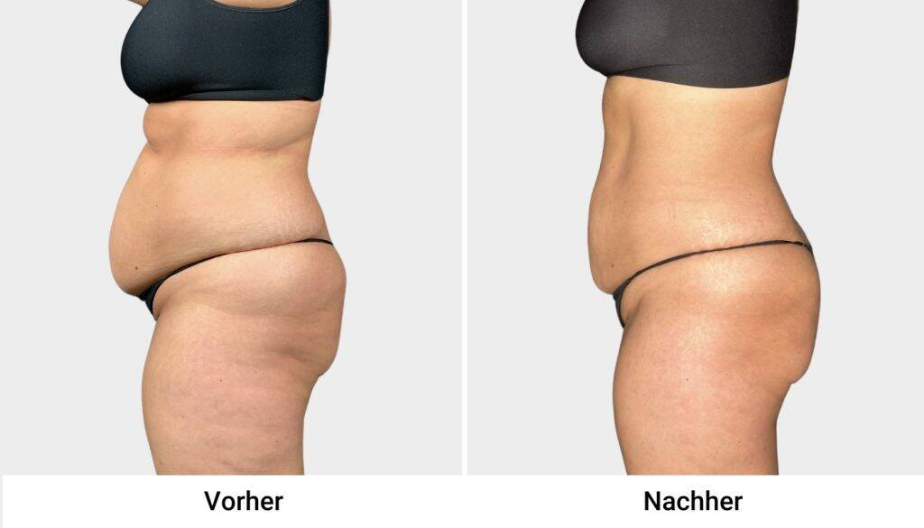 kryo vorher nachher 2