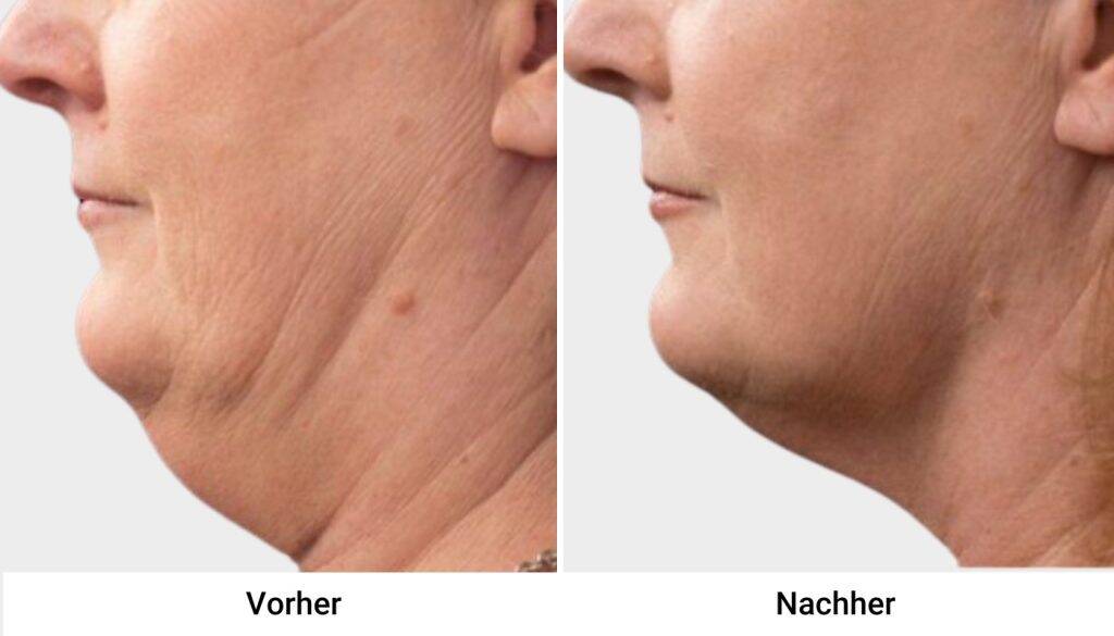 kryo vorher nachher 3