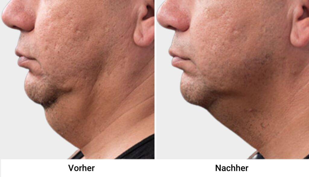 kryo vorher nachher 5
