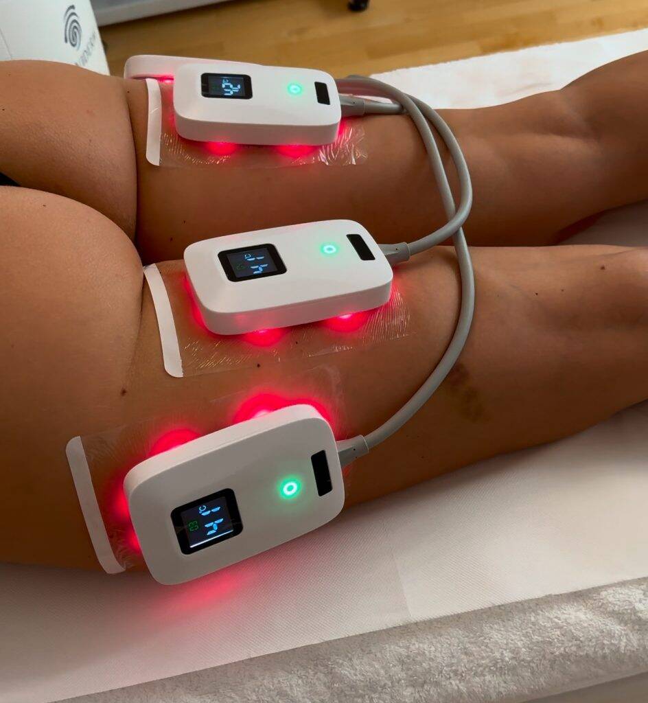 Cellulite Behandlung 1 MD Sculpt ID